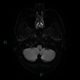 Acute posterior cerebral artery territory infarct (Radiopaedia 79329-92394 Axial DWI 5).jpg