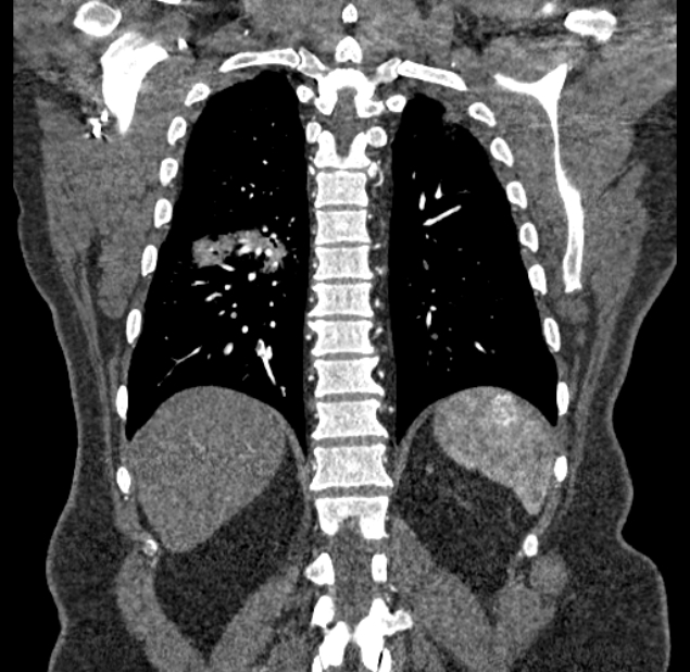Acute pulmonary embolism with pulmonary infarcts (Radiopaedia 77688-89908 Coronal C+ CTPA 79).jpg