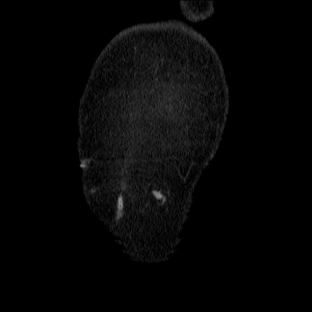 Acute pyelonephritis (Radiopaedia 26584-26729 C+ portal venous phase 5).jpg
