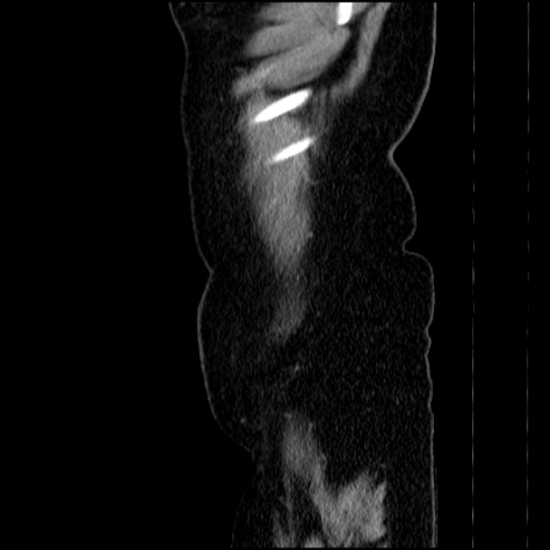 Acute pyelonephritis (Radiopaedia 33397-34434 Sagittal renal parenchymal phase 8).jpg