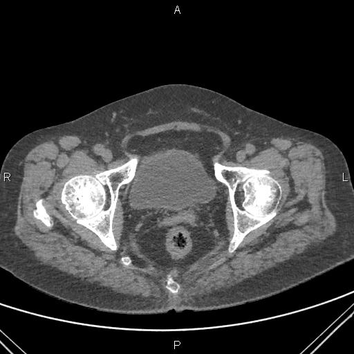 File:Acute renal artery occlusion (Radiopaedia 86586-102682 Axial non-contrast 89).jpg