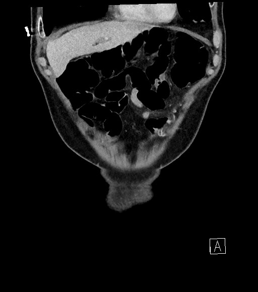 Acute renal infarction (Radiopaedia 59375-66736 Coronal C+ portal venous phase 15).jpg