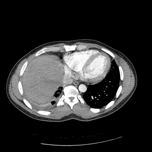 Acute segmental pulmonary emboli and pulmonary infarction (Radiopaedia 62264-70444 Axial C+ CTPA 86).jpg