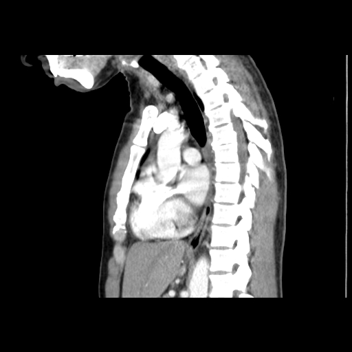 File:Acute segmental pulmonary emboli and pulmonary infarction (Radiopaedia 62264-70444 Sagittal C+ CTPA 35).jpg