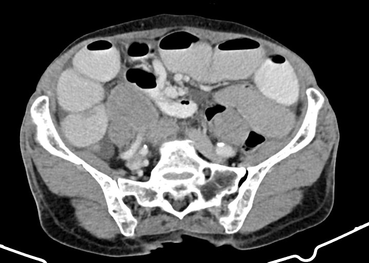 Acute small bowel (ileal) volvulus (Radiopaedia 71740-82139 Axial C+ portal venous phase 144).jpg