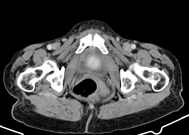 Acute small bowel (ileal) volvulus (Radiopaedia 71740-82139 Axial C+ portal venous phase 195).jpg