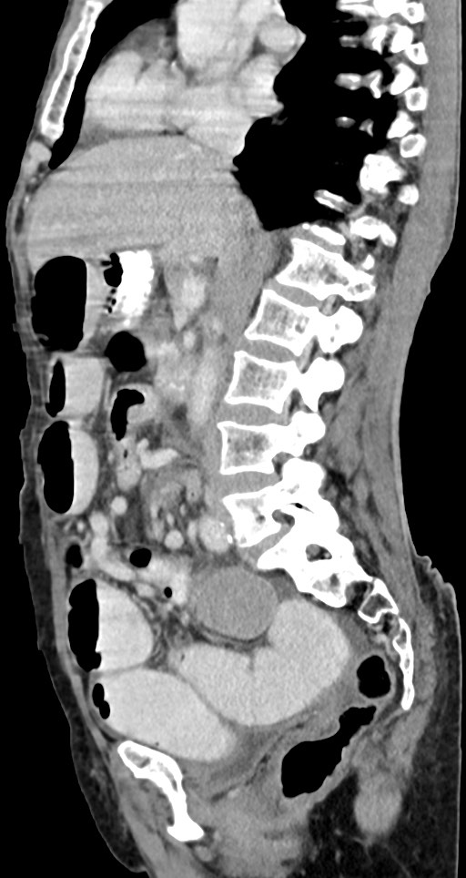 Acute small bowel (ileal) volvulus (Radiopaedia 71740-82139 Sagittal C+ portal venous phase 94).jpg