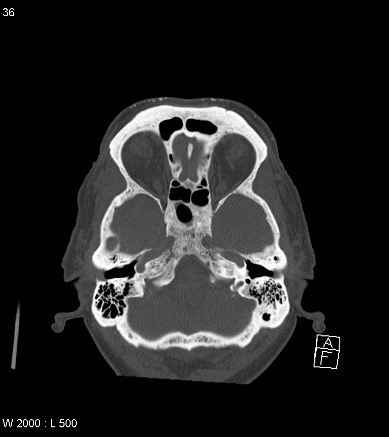 Acute subdural hematoma with myelofibrosis (Radiopaedia 52582-58494 Axial bone window 18).jpg