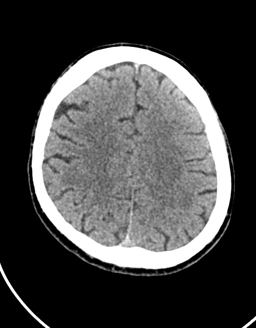 Acute superior cerebellar artery territory infarct (Radiopaedia 84104-99359 Axial non-contrast 24).jpg