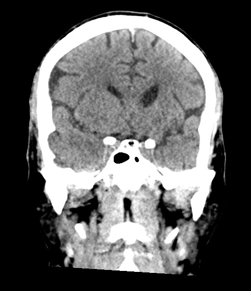 File:Acute superior cerebellar artery territory infarct (Radiopaedia 84104-99359 Coronal non-contrast 43).jpg