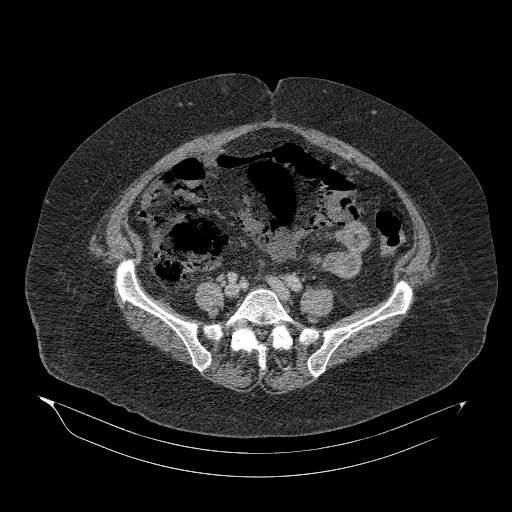 Acute superior mesenteric artery occlusion (Radiopaedia 51288-56960 Axial C+ portal venous phase 70).jpg