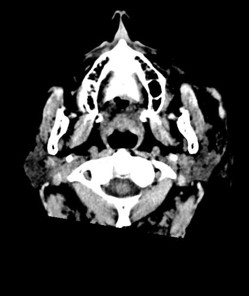 Acute traumatic subdural hematoma (Radiopaedia 82921-97257 Axial non-contrast 64).jpg