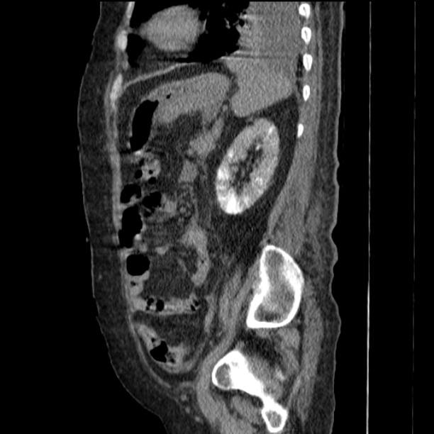 Acute tubular necrosis (Radiopaedia 28077-28334 H 62).jpg