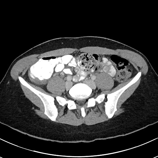 File:Acute uncomplicated appendicitis (Radiopaedia 61374-69304 Axial 10).jpg