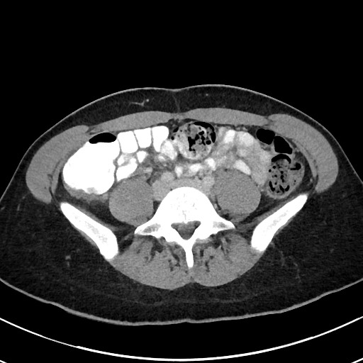 Acute uncomplicated appendicitis (Radiopaedia 61374-69304 Axial C+ portal venous phase 76).jpg