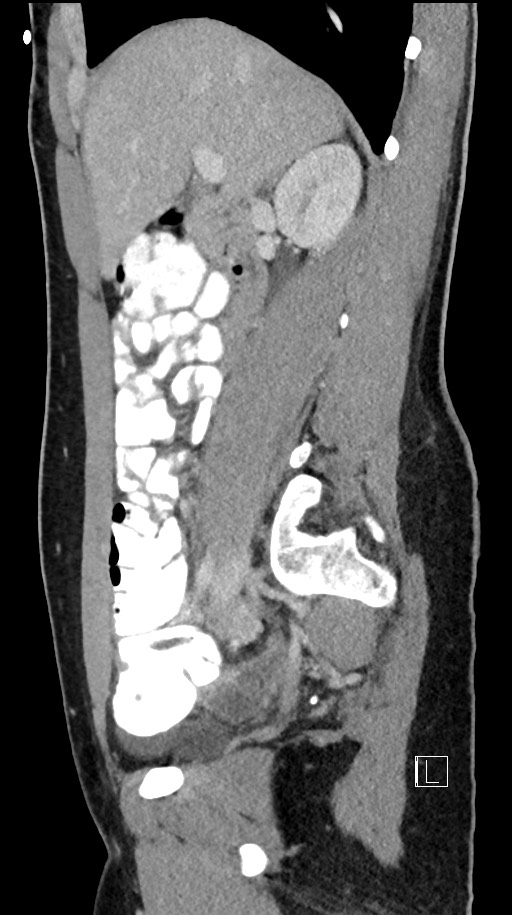 Acute uncomplicated appendicitis (Radiopaedia 61374-69304 Sagittal C+ portal venous phase 65).jpg