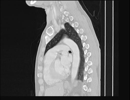 File:Addison disease (Radiopaedia 49318-54412 Sagittal lung window 26).jpg
