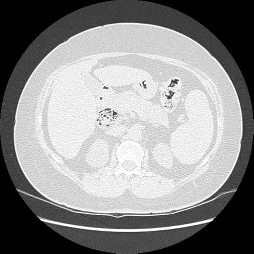 Adenocarcinoma in situ of lung (Radiopaedia 38685-40829 B 237).png