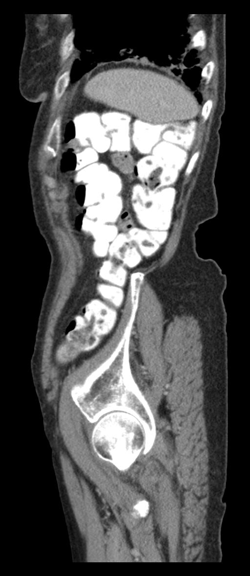 Adenocarcinoma of cecum (Radiopaedia 59222-66549 Sagittal C+ portal venous phase 6).jpg