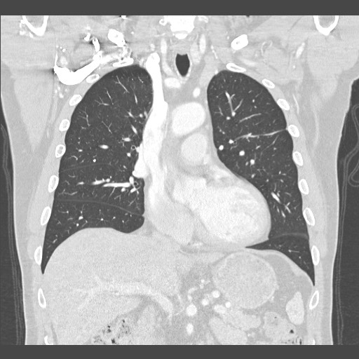 Adenocarcinoma of the lung (Radiopaedia 59871-67325 Coronal lung window 23).jpg