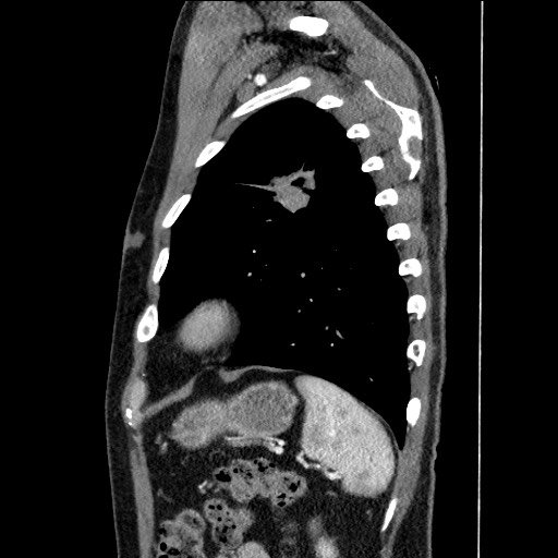 Adenocarcinoma of the lung (Radiopaedia 59871-67325 Sagittal C+ arterial phase 84).jpg