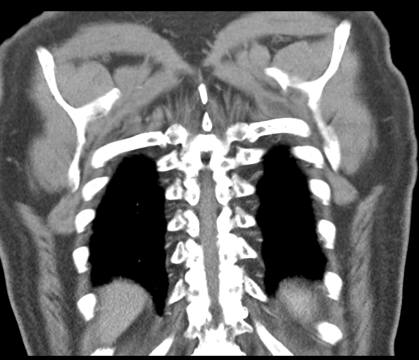 Adenocarcioma of rectum- T1 lesion (Radiopaedia 36921-38547 Coronal C+ arterial phase 53).png