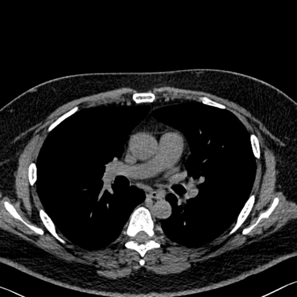 Adenoid cystic carcinoma of the trachea (Radiopaedia 49042-54137 Axial non-contrast 163).jpg