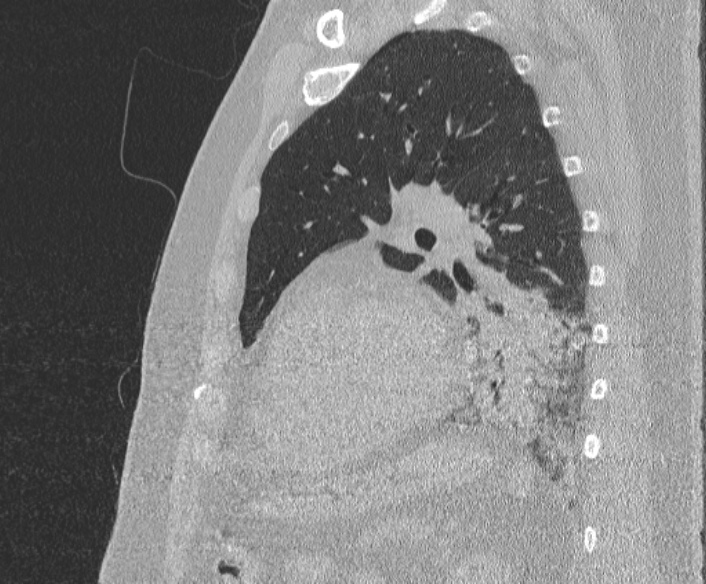 File:Adenoid cystic carcinoma of the trachea (Radiopaedia 49042-54137 Sagittal lung window 312).jpg