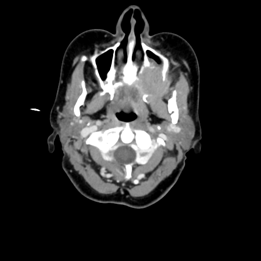 File:Adenoid cystic tumor of palate (Radiopaedia 46980-51518 Axial C+ delayed 27).png