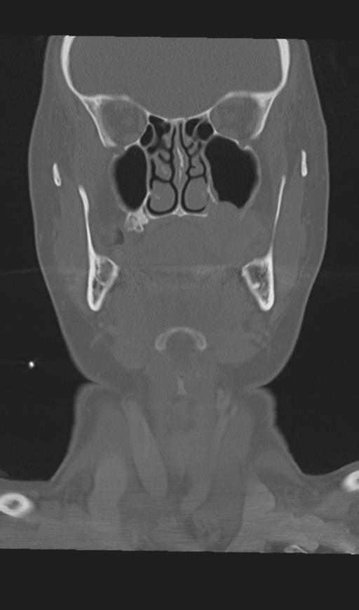 Adenoid cystic tumor of palate (Radiopaedia 46980-51518 Coronal bone window 26).png