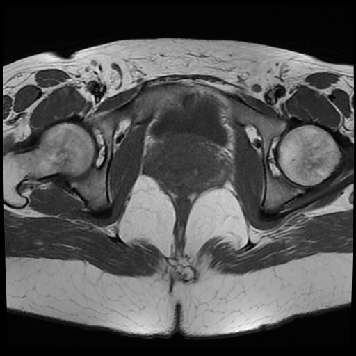 File:Adenomyosis-scar endometriosis (Radiopaedia 65863-75022 Axial T1 25).jpg