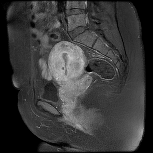 File:Adenomyosis-scar endometriosis (Radiopaedia 65863-75022 Sagittal T1 C+ fat sat 15).jpg