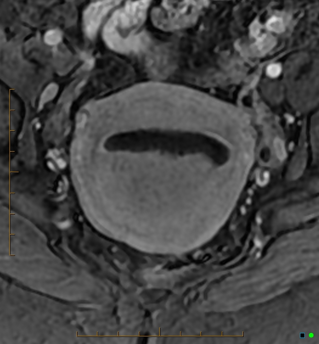 Adenomyosis uterus with hematometra (Radiopaedia 45779-50011 Axial T1 C+ fat sat 28).jpg