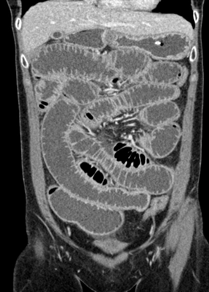 Adhesional small bowel obstruction (Radiopaedia 48397-53305 Coronal C+ portal venous phase 109).jpg