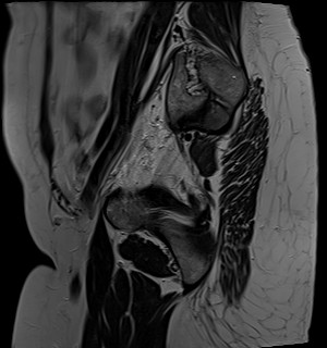 File:Adnexal multilocular cyst (O-RADS US 3- O-RADS MRI 3) (Radiopaedia 87426-103754 Sagittal T2 1).jpg