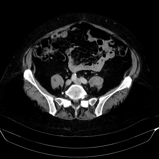 Adrenal cortical carcinoma (Radiopaedia 64017-72769 Axial C+ portal venous phase 50).jpg