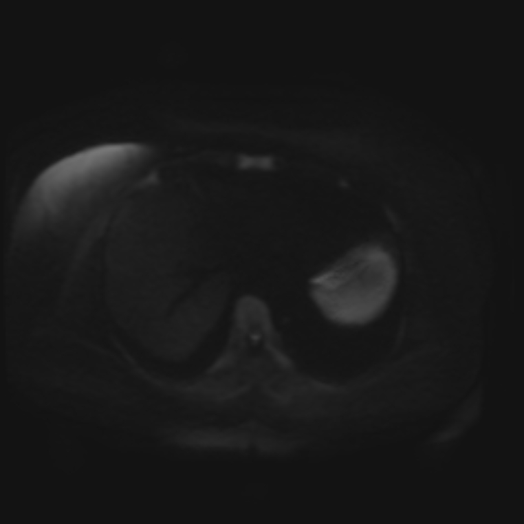 Adrenal cortical carcinoma (Radiopaedia 70906-81116 Axial DWI 32).jpg