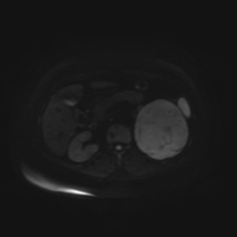 Adrenal cortical carcinoma (Radiopaedia 70906-81116 Axial DWI 42).jpg