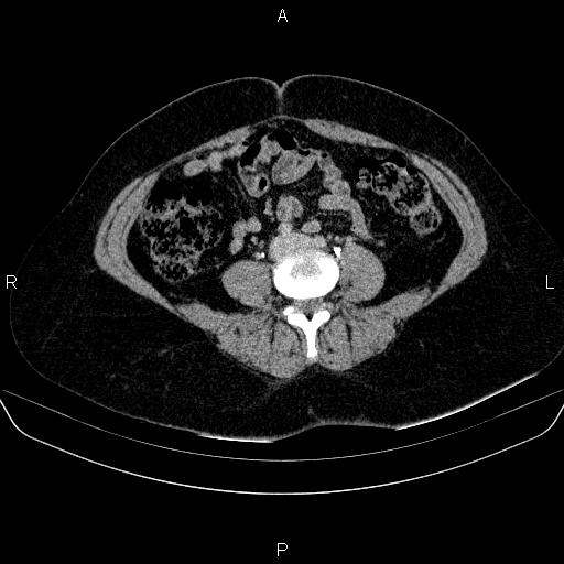 Adrenal cortical carcinoma (Radiopaedia 84882-100379 Axial C+ delayed 57).jpg