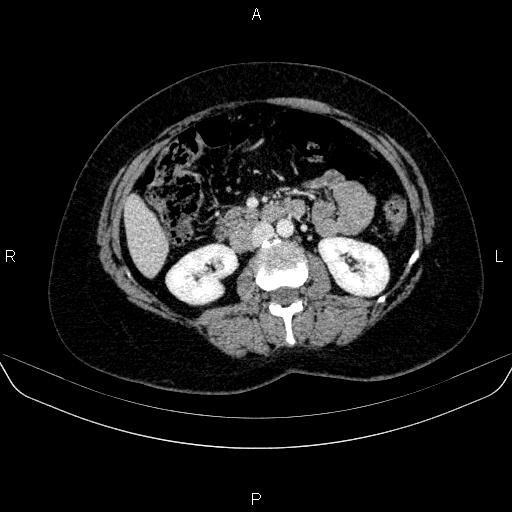 Adrenal cortical carcinoma (Radiopaedia 84882-100379 Axial C+ portal venous phase 41).jpg
