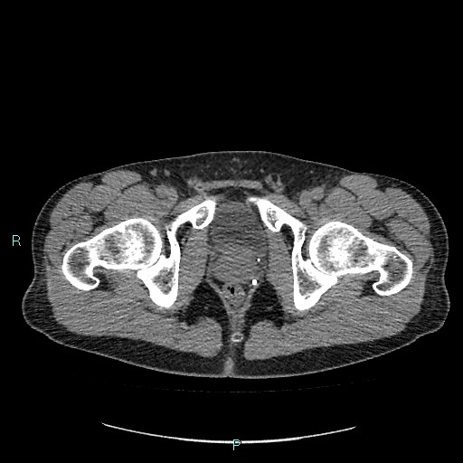 Adrenal cystic lymphangioma (Radiopaedia 83161-97534 Axial non-contrast 98).jpg