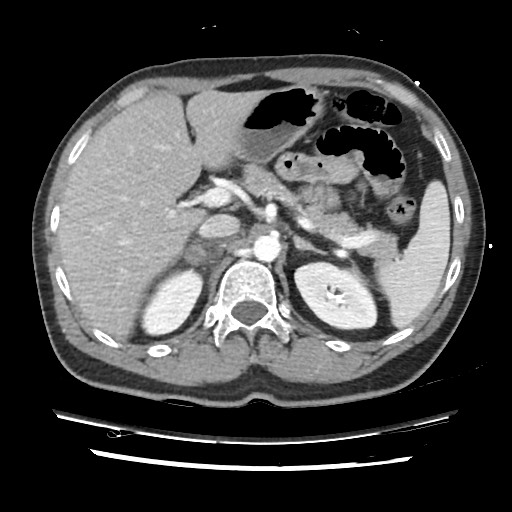 Adrenal gland trauma (Radiopaedia 81351-95078 Axial Dual bolus trauma C+ 64).jpg