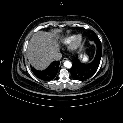 Adrenal hemorrhage (Radiopaedia 62622-70916 Axial C+ arterial phase 28).jpg