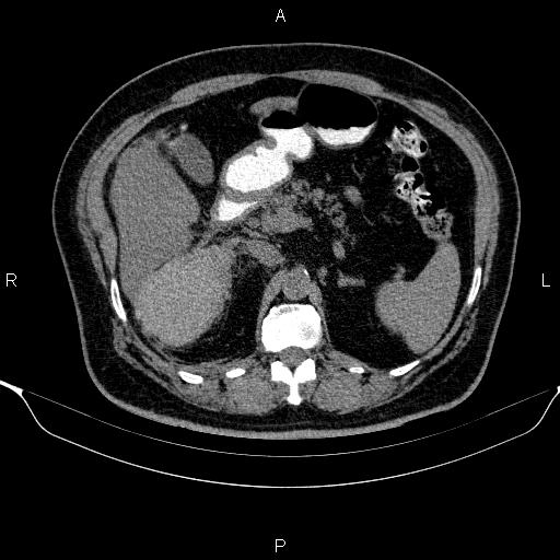 Adrenal hemorrhage (Radiopaedia 62622-70916 Axial non-contrast 63).jpg