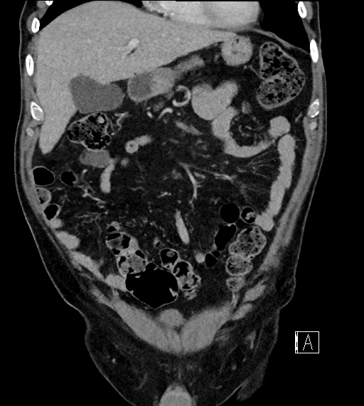 Adrenal lymphoma (Radiopaedia 73730-84529 Coronal C+ portal venous phase 24).jpg