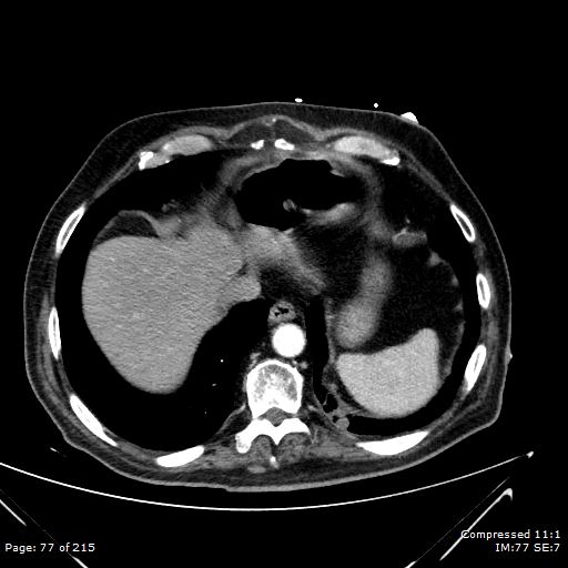 Adrenal metastasis (Radiopaedia 78425-91079 Axial C+ arterial phase 7).jpg