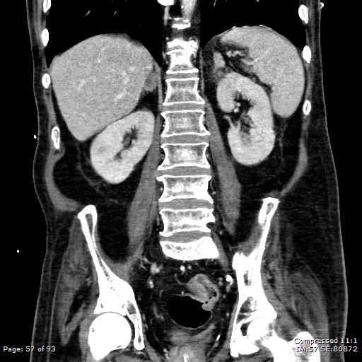 File:Adrenal metastasis (Radiopaedia 78425-91079 Sagittal C+ portal venous phase 44).jpg