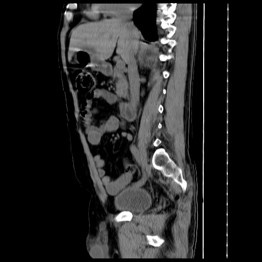 File:Adrenal myelolipoma (Radiopaedia 41843-44834 Sagittal non-contrast 20).jpg