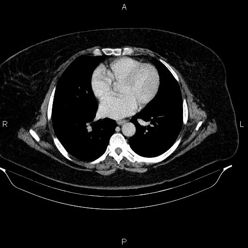 Adrenal myelolipoma (Radiopaedia 84319-99617 Axial renal cortical phase 5).jpg