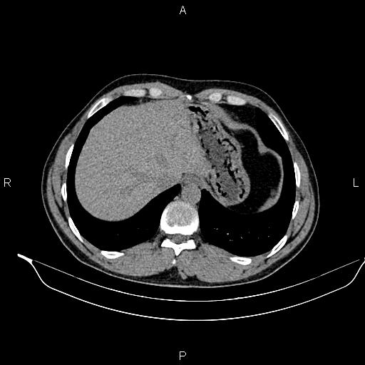 Adrenal myelolipoma (Radiopaedia 87794-104246 Axial non-contrast 17).jpg